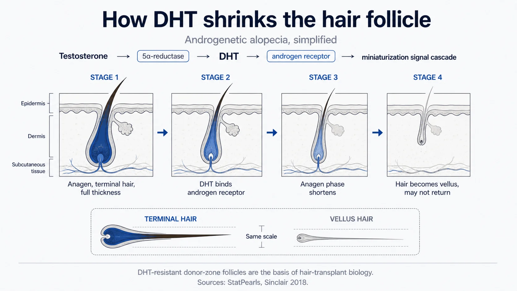 Diagram showing DHT binding to follicle receptor causing progressive miniaturisation across hair cycles