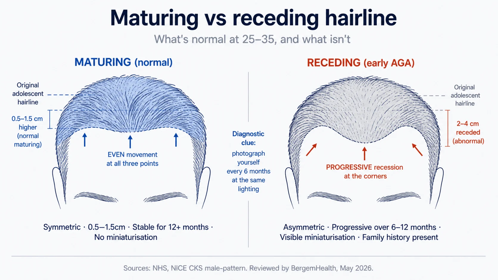 Side-by-side line drawing of a maturing hairline and an early-AGA receding hairline