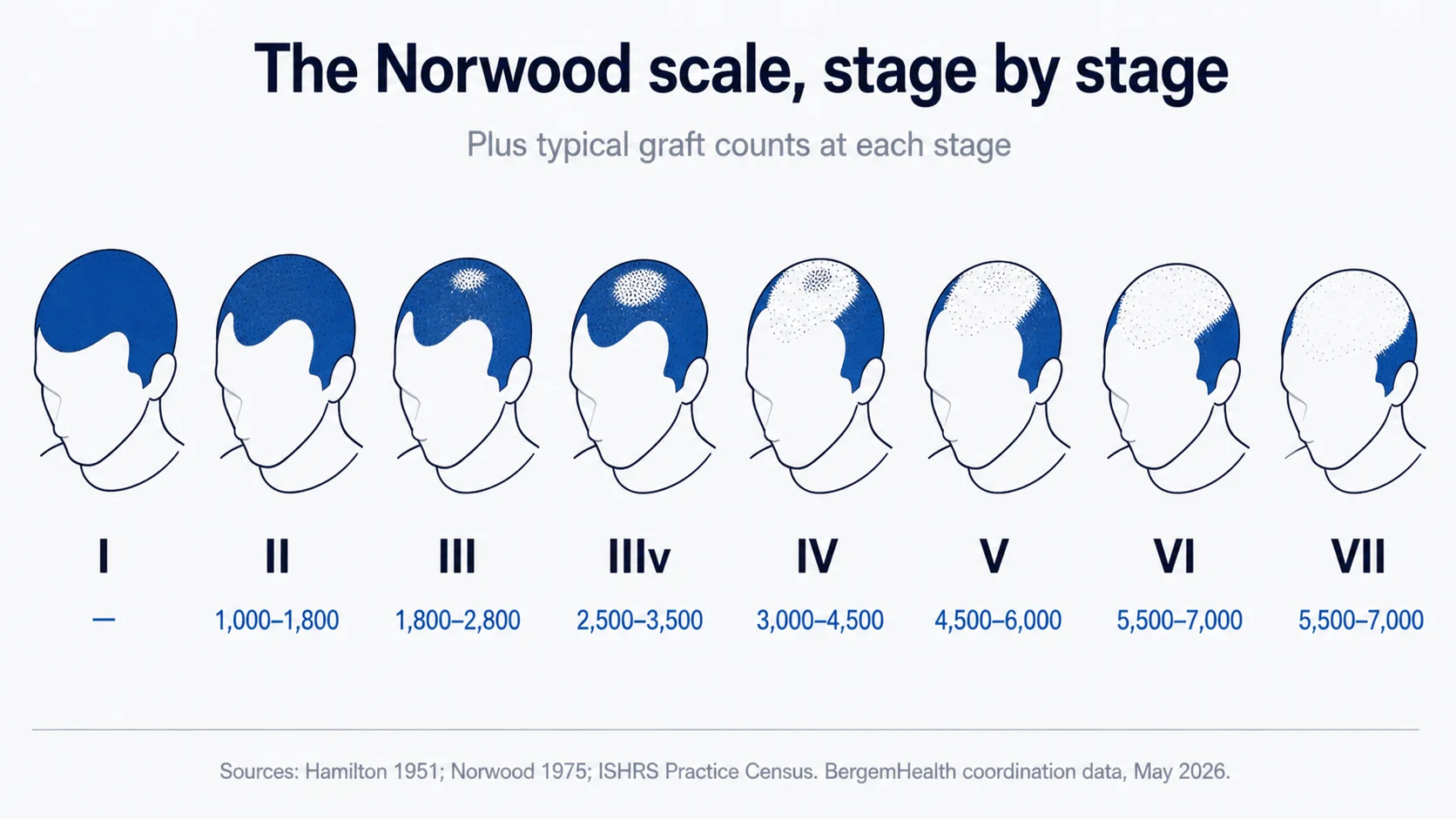 Norwood scale 1 to 7 stages illustrated in line drawing on white