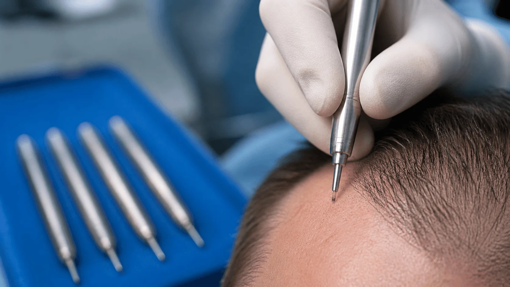Direct DHI hair transplant — surgeon using Choi implanter pen to place a single follicular unit into the recipient site at a controlled angle and depth