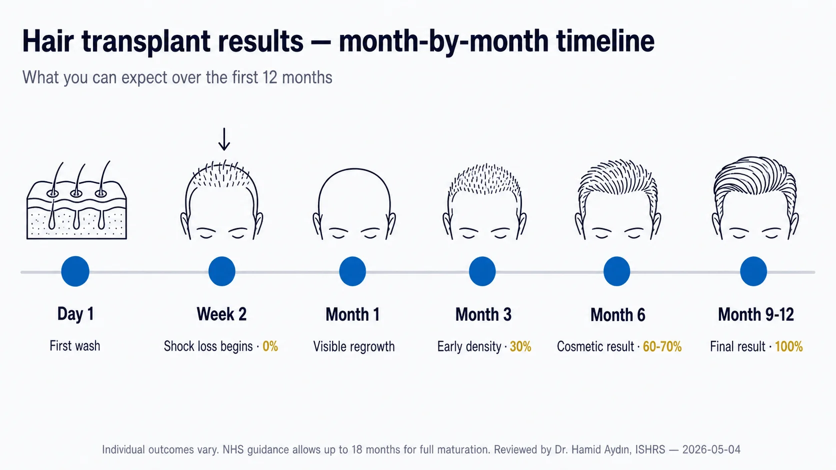Hair transplant results timeline from day 0 to month 12 showing density evolution