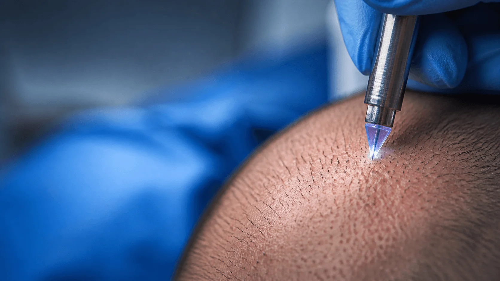 Sapphire FUE channel opening with V-shaped sapphire-crystal blade — surgeon controlling angle and direction of recipient sites for dense graft packing