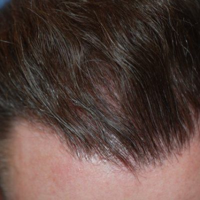 James T. · UK — 4,200 grafts · Norwood IV → restored hairline