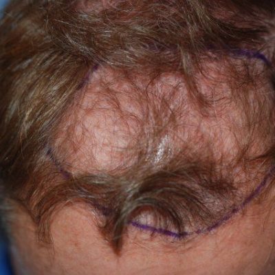 James T. · UK — 4,200 grafts · Norwood IV → restored hairline