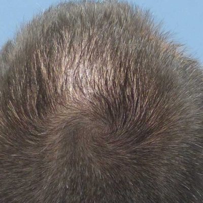 Markus H. · Germany — 3,500 grafts · receding hairline → natural restored