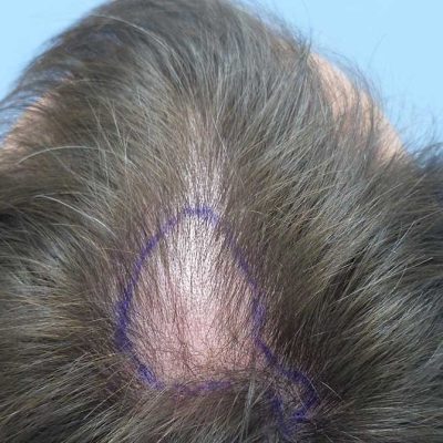 Markus H. · Germany — 3,500 grafts · receding hairline → natural restored
