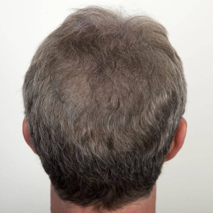 Stefan V. · Netherlands — 5,000 grafts · diffuse thinning → full density