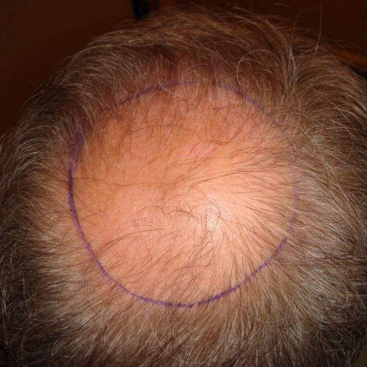 Stefan V. · Netherlands — 5,000 grafts · diffuse thinning → full density