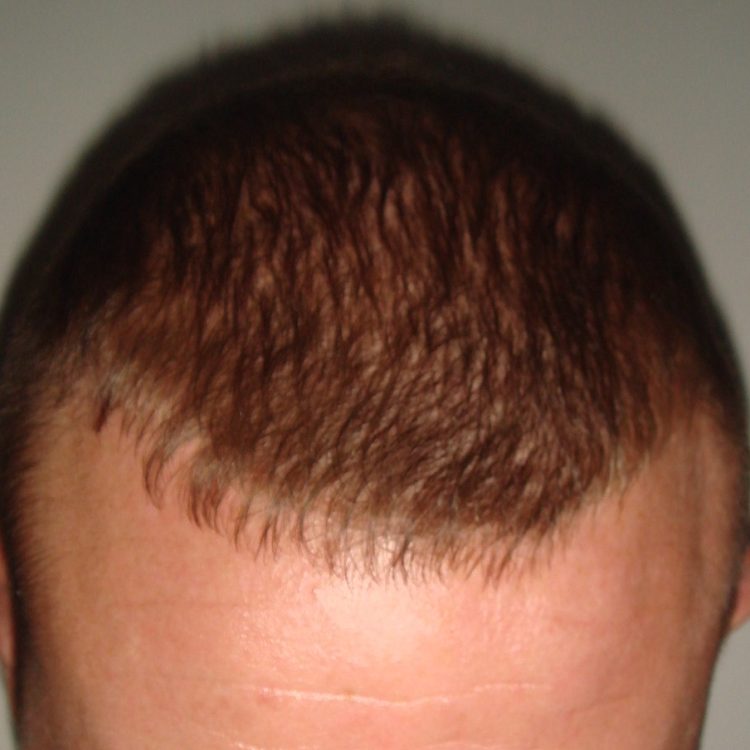 Same patient 12 months after FUE hair transplant