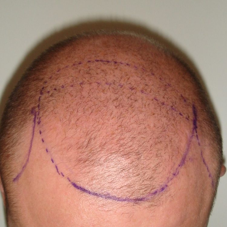 Patient before hair transplant